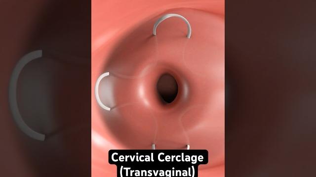 Stitching the cervix to prevent miscarriage (3d animation Stitching the cervix to prevent miscarriage (3d animation