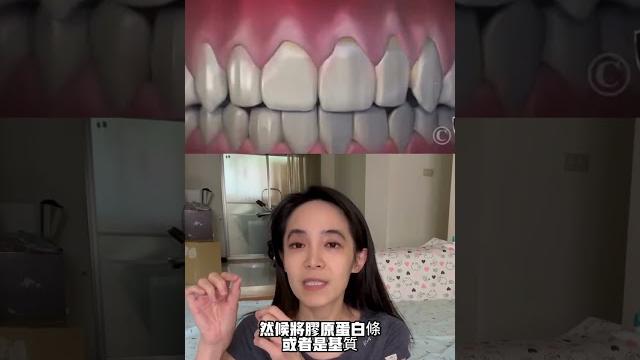 改善黑三角三個方法:修牙縫、補牙齦、瓷貼片或補牙#牙套#針孔微創手術 改善黑三角三個方法:修牙縫、補牙齦、瓷貼片或補牙#牙套#針孔微創手術