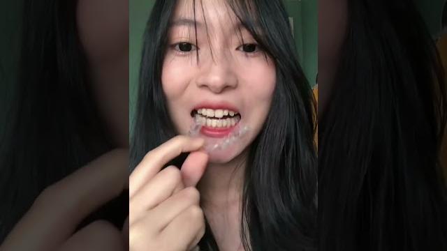 沉浸式-摘隐形牙套 口水拉丝是正常的 沉浸式-摘隐形牙套 口水拉丝是正常的