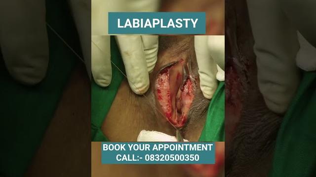 Labiaplasty surgery, vagina tighten, plastic surgery at elegance clinic in vesu, surat Labiaplasty surgery, vagina tighten, plastic surgery at elegance clinic in vesu, surat