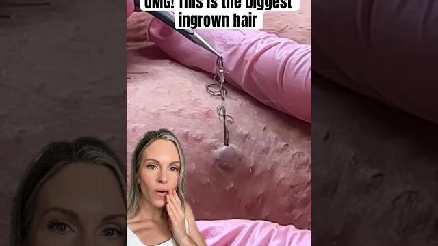 Omg! this is the worlds biggest ingrown hair removal! #shorts Omg! this is the worlds biggest ingrown hair removal! #shorts