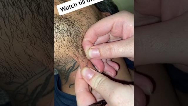 Blackheads & milia , big cystic acne blackheads extraction whiteheads removal pimple popping. #270 Blackheads & milia , big cystic acne blackheads extraction whiteheads removal pimple popping. #270