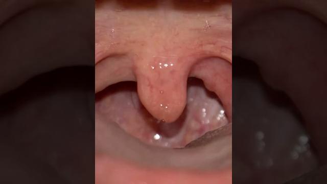 What causes a crooked uvula? #uvula What causes a crooked uvula? #uvula