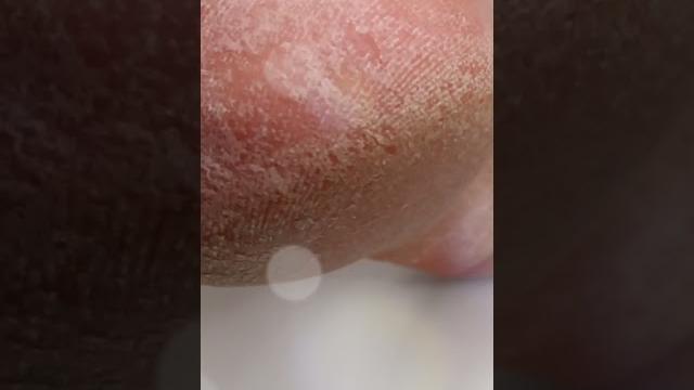 Remove dead skin cells from feet in minutes #shorts Remove dead skin cells from feet in minutes #shorts