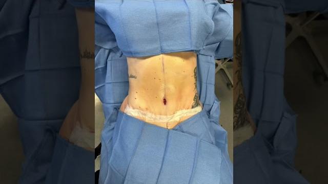 I’m 6 days post op mommy makeover! I’m 6 days post op mommy makeover!