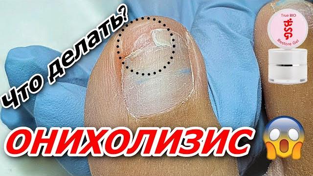 Онихолизис и как с ним работать Онихолизис и как с ним работать