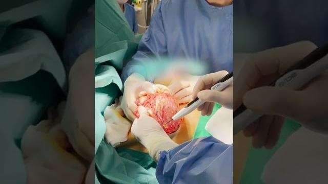 Plastic surgeon g. samulenas removing breast implants for a patient with capsular contracture. Plastic surgeon g. samulenas removing breast implants for a patient with capsular contracture.