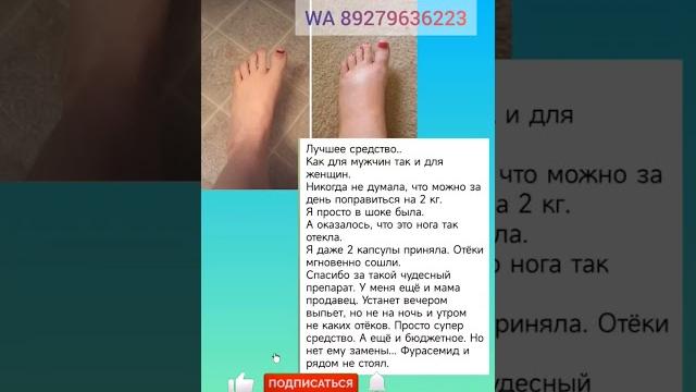 Отек, отеки ног, отекают ноги, отёчность Отек, отеки ног, отекают ноги, отёчность