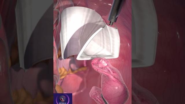 Laparoscopic tissue removal #shorts #medicalsurgery Laparoscopic tissue removal #shorts #medicalsurgery