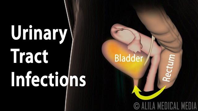 Urinary tract infections, animation. Urinary tract infections, animation.