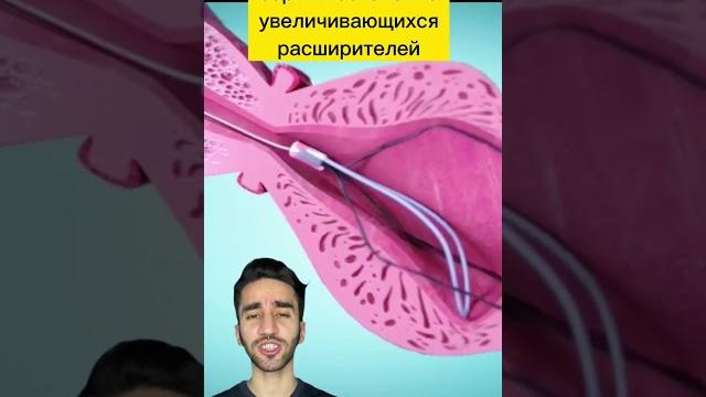 Расширение уретры при стриктуре уретры Расширение уретры при стриктуре уретры