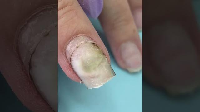 What happened after using nail glue What happened after using nail glue