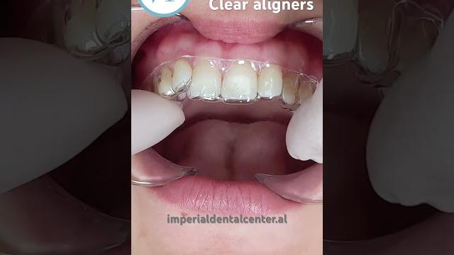 Clear aligners - this is how you put them #aligner #dentist #dental #teeth #clearaligners Clear aligners - this is how you put them #aligner #dentist #dental #teeth #clearaligners