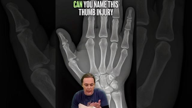 Why this painful thumb injury is often missed⁉️ Why this painful thumb injury is often missed⁉️