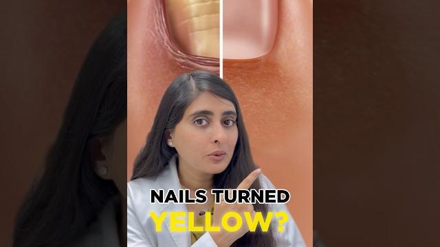 Nail fungal infection treatment | how to get rid of toenail fungus | nail fungal infection Nail fungal infection treatment | how to get rid of toenail fungus | nail fungal infection