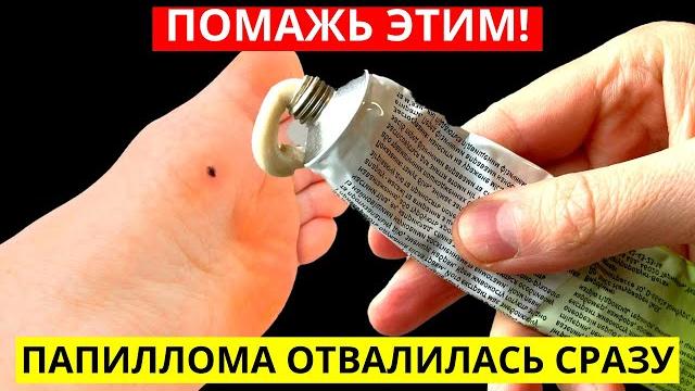 Левомеколь нанесла на ватный тампон и прикладываю на ночь папилломы боятся этой смеси как огня! Левомеколь нанесла на ватный тампон и прикладываю на ночь папилломы боятся этой смеси как огня!