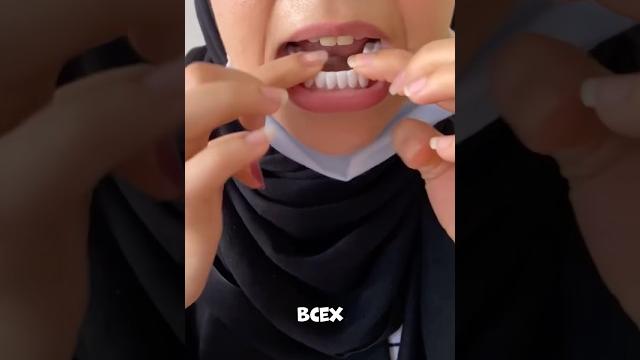 Самые практичные накладные виниры Самые практичные накладные виниры