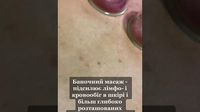 Баночний масаж. масаж банками. вакуумний масаж. банки на спину. масаж спини. массаж спины #massage Баночний масаж. масаж банками. вакуумний масаж. банки на спину. масаж спини. массаж спины #massage