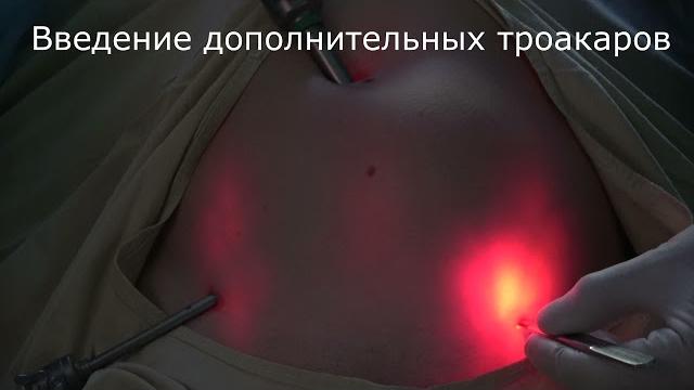 Лапароскопия. начальный этап. введение иглы вереша. создание пневмоперитонеума. введение троакаров. Лапароскопия. начальный этап. введение иглы вереша. создание пневмоперитонеума. введение троакаров.