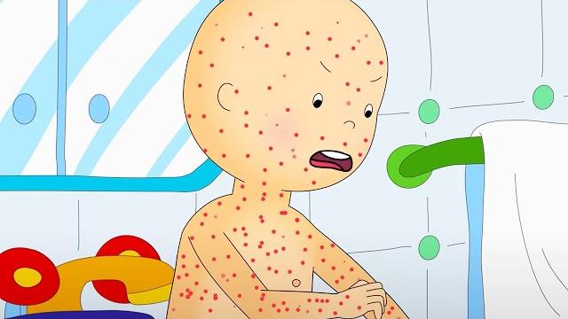 Chicken pox | caillou cartoon Chicken pox | caillou cartoon