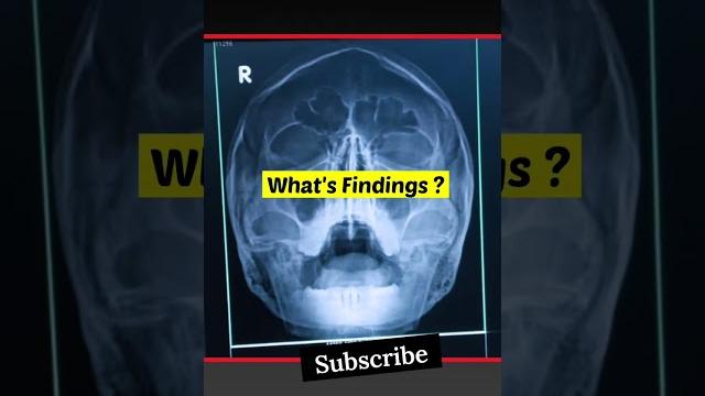 Digital x-ray pns water view #xray #shorts Digital x-ray pns water view #xray #shorts