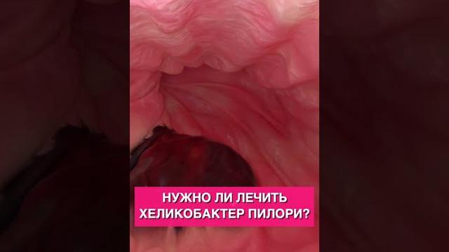 Нужно ли лечить хеликобактер пилори? Нужно ли лечить хеликобактер пилори?