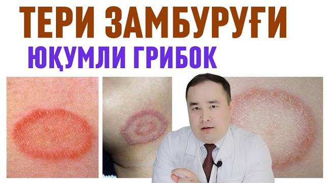 Терида тошмали замбуруғ касаллиги ва уй шароитида давоси хақида / микоз гибок / исчанов Терида тошмали замбуруғ касаллиги ва уй шароитида давоси хақида / микоз гибок / исчанов