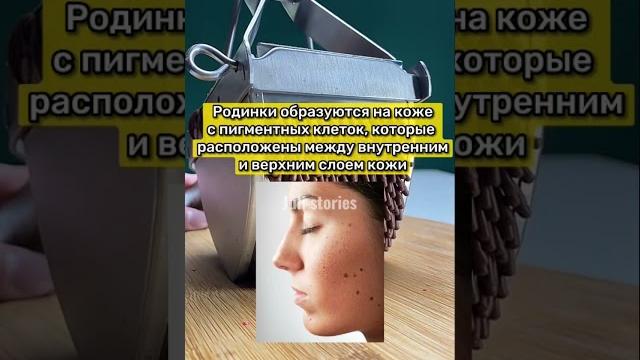 Почему появляются родинки Почему появляются родинки