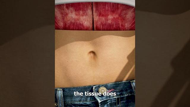 What causes an outie belly button? What causes an outie belly button?