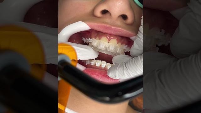 How braces are put on How braces are put on