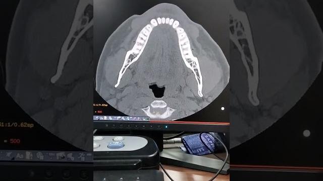 Ct scan of pns.#viral #medical #shortfeeds . Ct scan of pns.#viral #medical #shortfeeds .