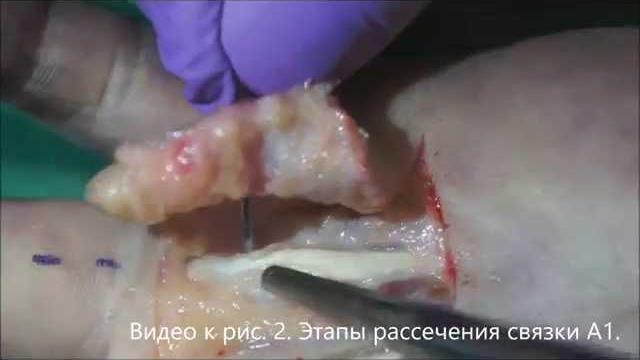 "щелкающий" палец "щелкающий" палец