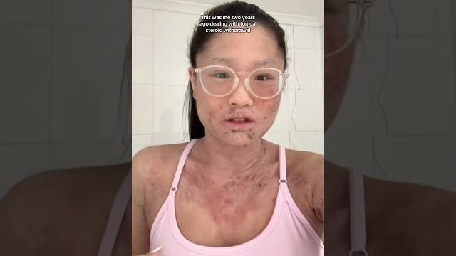 Healing eczema isn’t about the creams you use! #eczema #guthealth #tsw #topicalsteroidwithdrawal Healing eczema isn’t about the creams you use! #eczema #guthealth #tsw #topicalsteroidwithdrawal