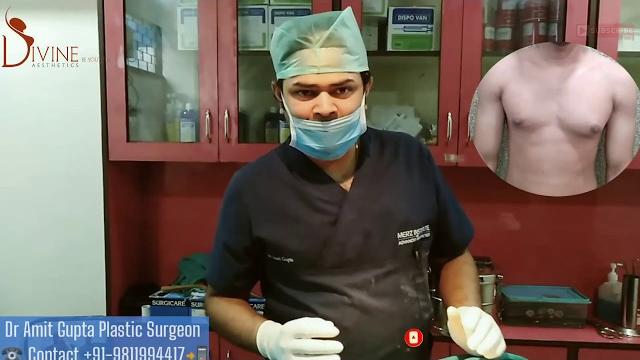 Puffy nipple grade 1 gynecomastia surgery at divine cosmetic surgery with dr amit gupta Puffy nipple grade 1 gynecomastia surgery at divine cosmetic surgery with dr amit gupta