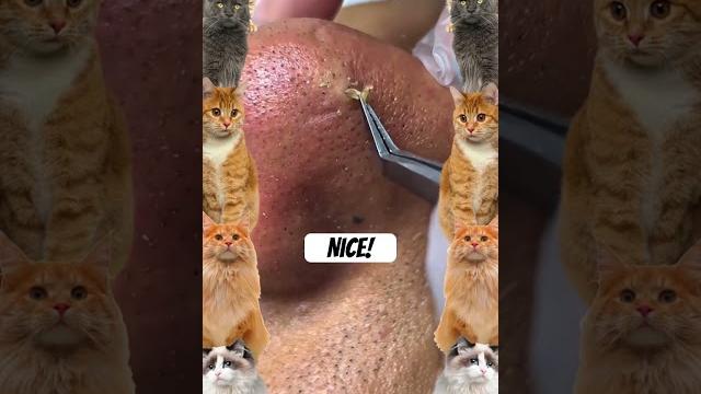 Wow! #pimple #pimplepopper #pimples #shortsfeed #shortvideo #shorts #short #youtubeshorts #youtube Wow! #pimple #pimplepopper #pimples #shortsfeed #shortvideo #shorts #short #youtubeshorts #youtube