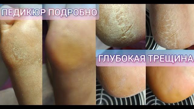 Мужской педикюр. очень глубокая трещина. трещины на пятках/аппаратный педикюр подробно. 修腳, 腳趾甲, 修指甲 Мужской педикюр. очень глубокая трещина. трещины на пятках/аппаратный педикюр подробно. 修腳, 腳趾甲, 修指甲