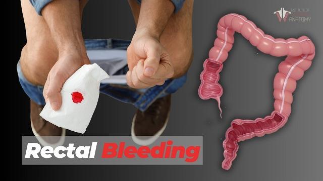 When to be worried about rectal bleeding When to be worried about rectal bleeding
