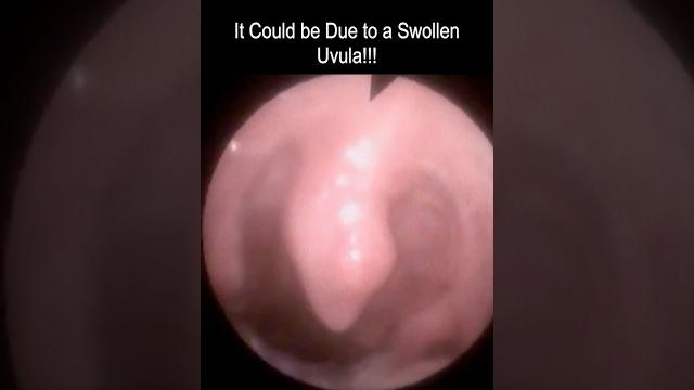 Swollen uvula causing lump sensation in throat #shorts #throatlump #globus @fauquierent Swollen uvula causing lump sensation in throat #shorts #throatlump #globus @fauquierent