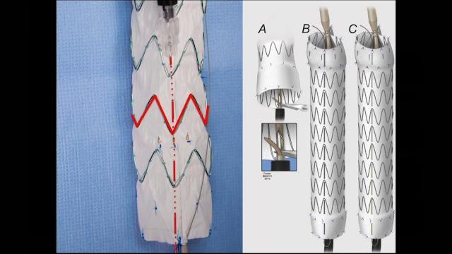 Dr. gustavo oderich - physician modified fenestrated endografts: technical aspects and outcomes Dr. gustavo oderich - physician modified fenestrated endografts: technical aspects and outcomes