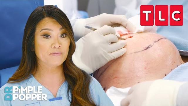 Biggest removals ever | dr. pimple popper | tlc Biggest removals ever | dr. pimple popper | tlc