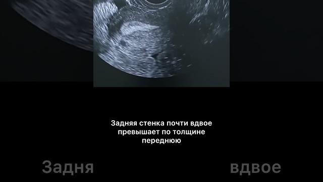 #узи #узималоготаза #аденомиоз #узи #узималоготаза #аденомиоз
