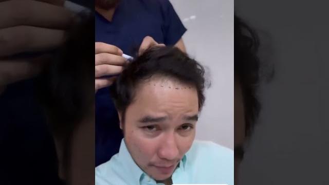 Ashgreyz jejestoryy selebgram indonesia tanam rambut di ilyas arslan turki #hairtransplant #skincare Ashgreyz jejestoryy selebgram indonesia tanam rambut di ilyas arslan turki #hairtransplant #skincare