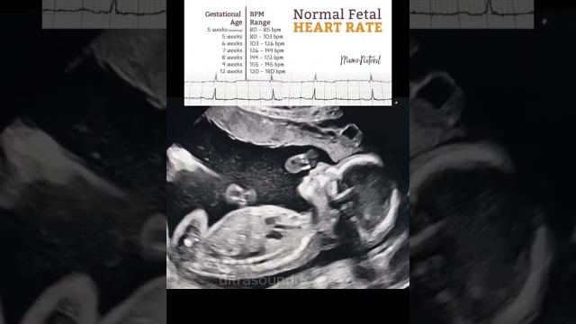 Fetal heart rate | ultrasound #baby #reels #shorts Fetal heart rate | ultrasound #baby #reels #shorts