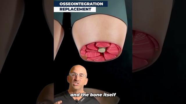 How metal bones help amputees walk again⁉️ How metal bones help amputees walk again⁉️