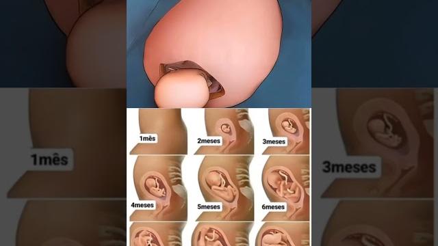 C- section video in few seconds #baby #pregnant C- section video in few seconds #baby #pregnant
