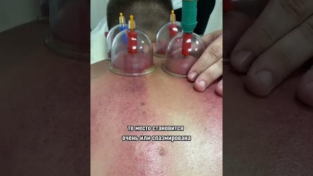 Для чего нужен баночный массаж? Для чего нужен баночный массаж?