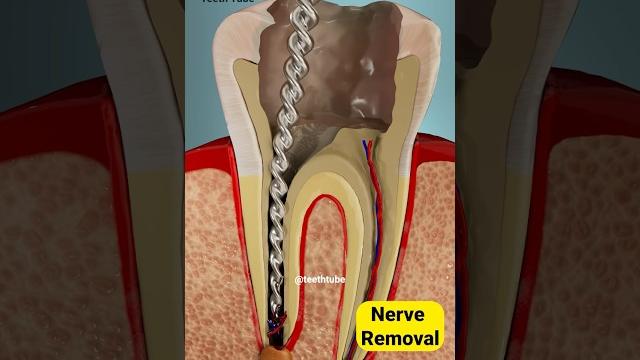 Root canal treatment 3d animation #shorts Root canal treatment 3d animation #shorts
