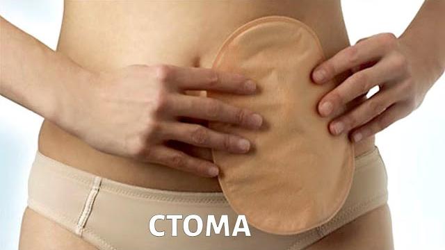 Кишечная стома: как жить, если удален кишечник? Кишечная стома: как жить, если удален кишечник?