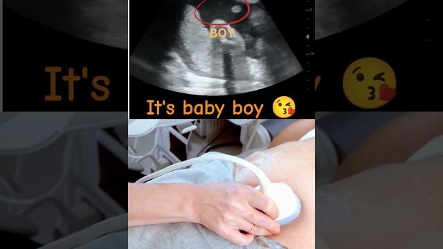 Ultrasound showing boy baby !!! Ultrasound showing boy baby !!!