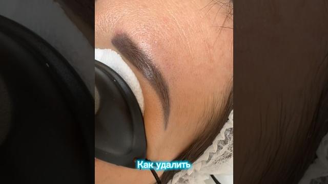 Удаление татуажа бровей лазером Удаление татуажа бровей лазером